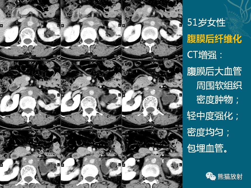 【PPT】腹膜后平滑肌肉瘤诊断及鉴别诊断
