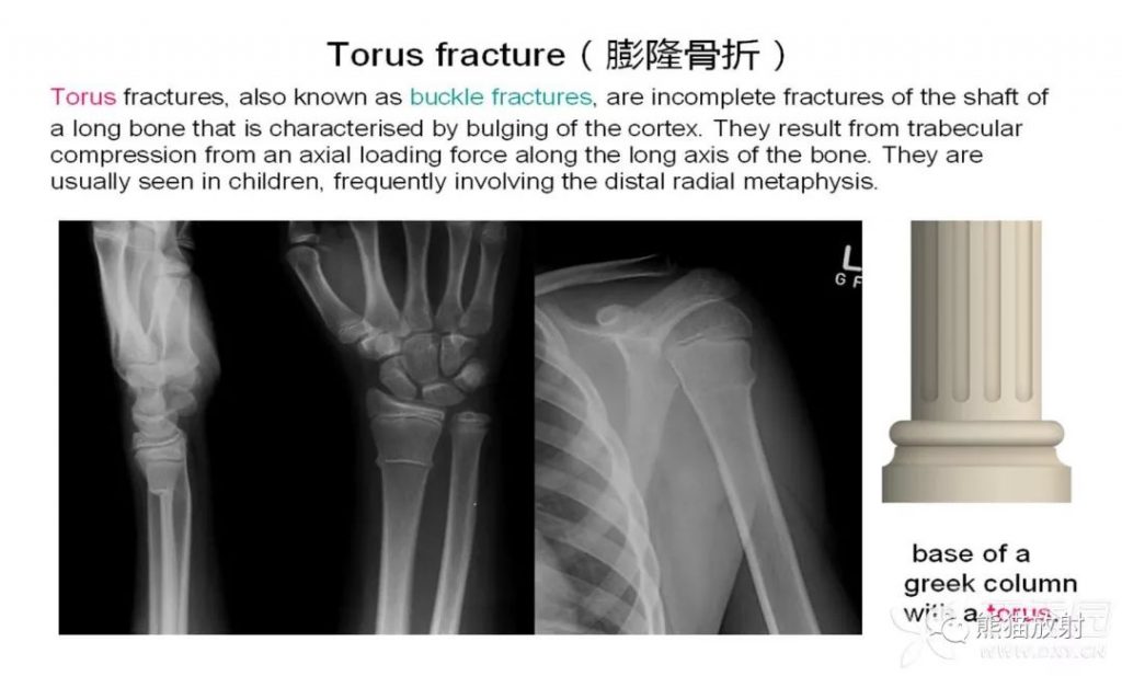 骨关节外伤特殊征象及名称