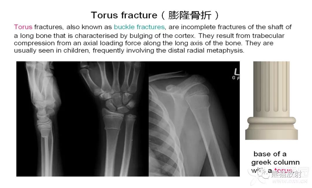 骨关节外伤特殊征象及名称 骨关节外伤特殊征象及名称