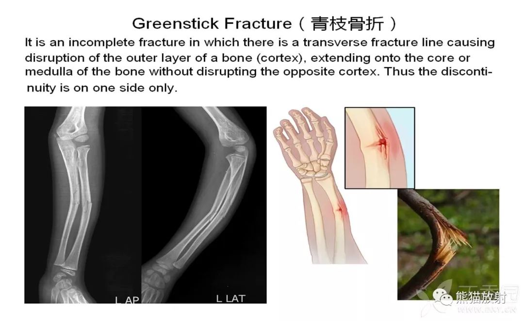 骨关节外伤特殊征象及名称 骨关节外伤特殊征象及名称