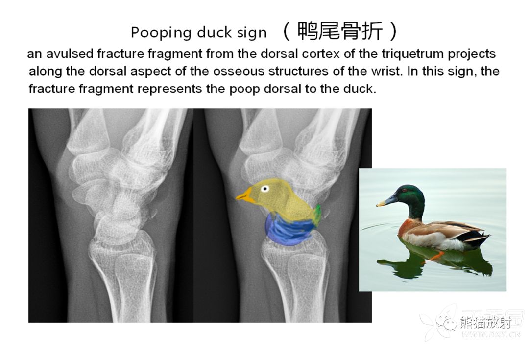 骨关节外伤特殊征象及名称 骨关节外伤特殊征象及名称