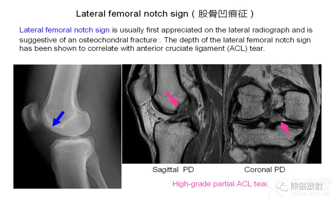 骨关节外伤特殊征象及名称 骨关节外伤特殊征象及名称