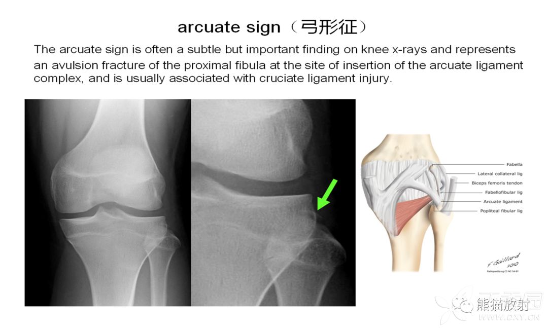 骨关节外伤特殊征象及名称 骨关节外伤特殊征象及名称