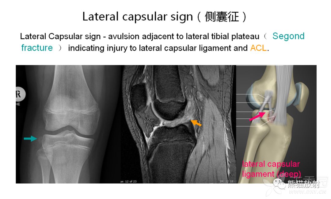 骨关节外伤特殊征象及名称 骨关节外伤特殊征象及名称