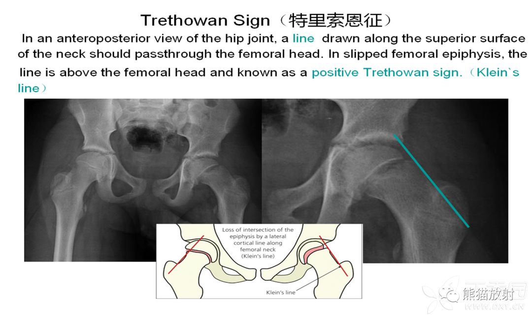 骨关节外伤特殊征象及名称 骨关节外伤特殊征象及名称