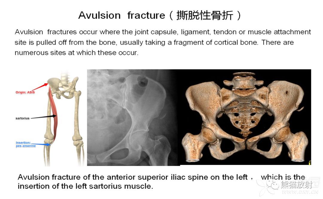 骨关节外伤特殊征象及名称 骨关节外伤特殊征象及名称