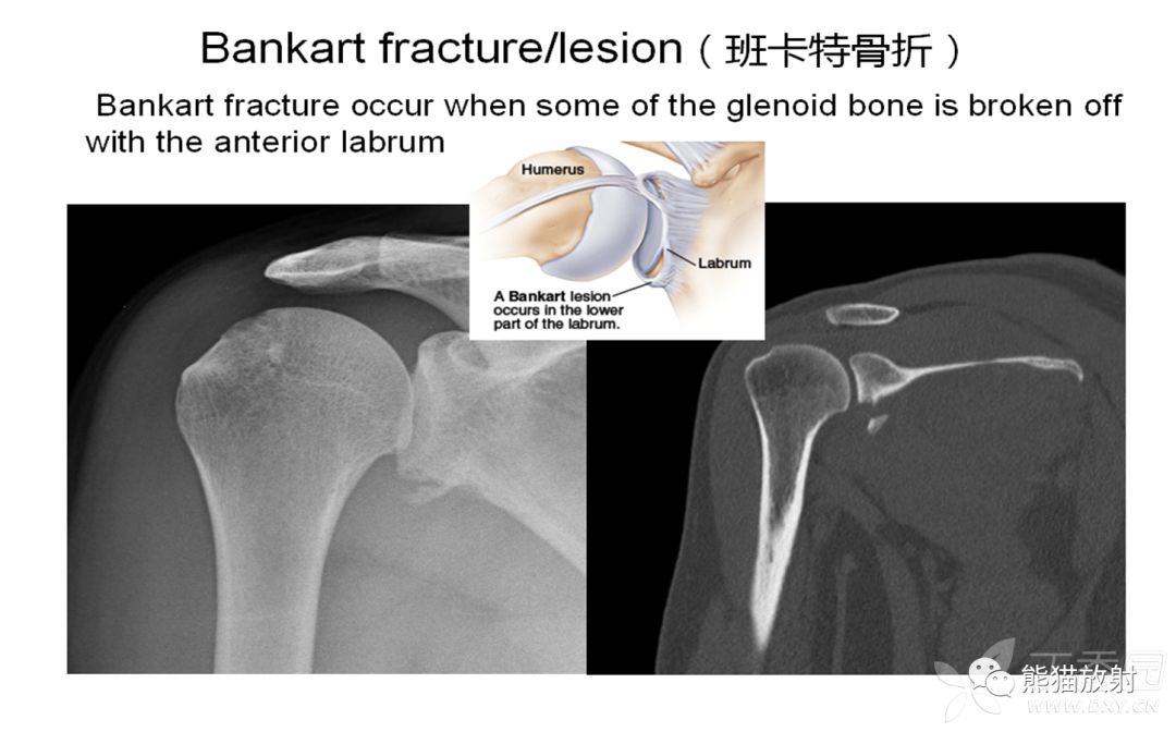 骨关节外伤特殊征象及名称 骨关节外伤特殊征象及名称
