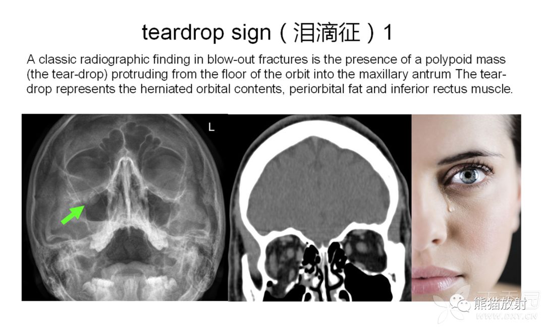 骨关节外伤特殊征象及名称 骨关节外伤特殊征象及名称