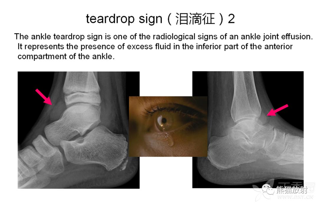 骨关节外伤特殊征象及名称 骨关节外伤特殊征象及名称