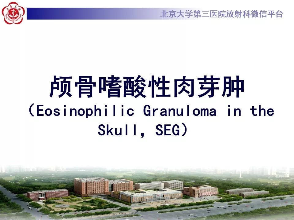 【PPT】颅骨嗜酸性肉芽肿