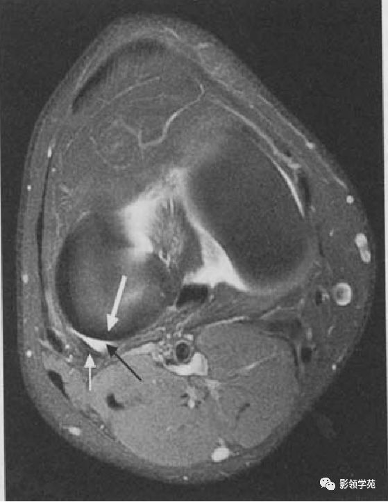 膝关节滑囊的影像解剖 膝关节滑囊的影像解剖