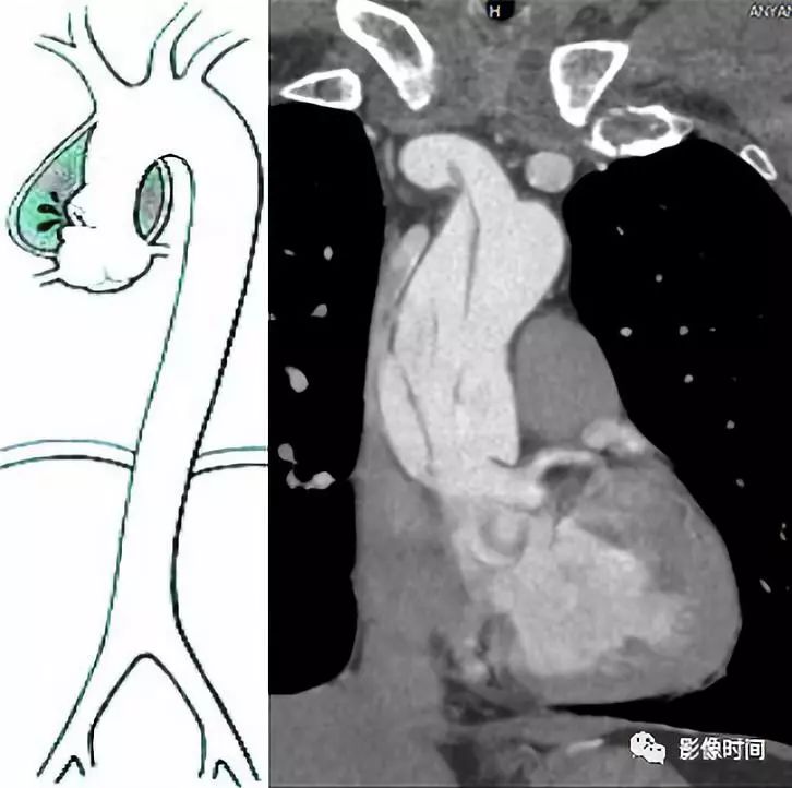 急性主动脉综合征影像 急性主动脉综合征影像