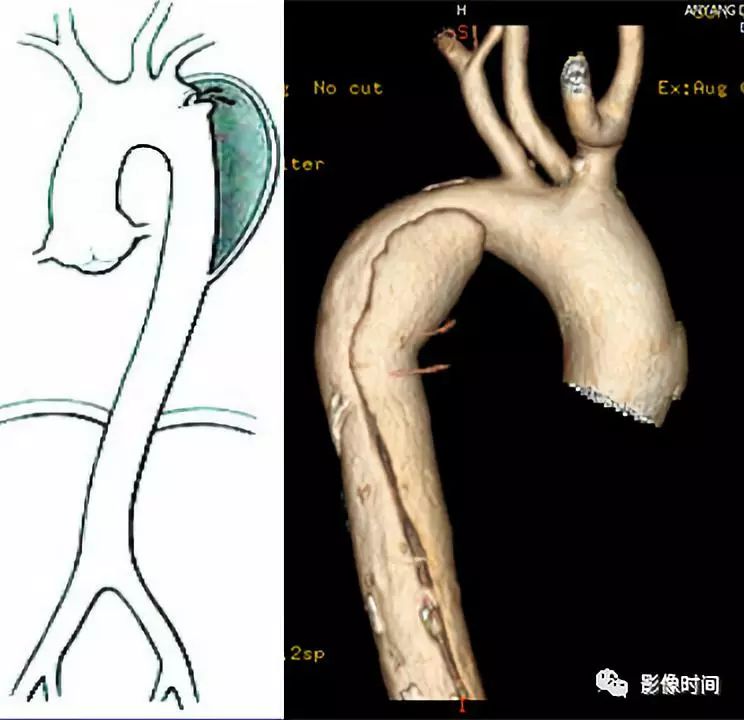 急性主动脉综合征影像 急性主动脉综合征影像