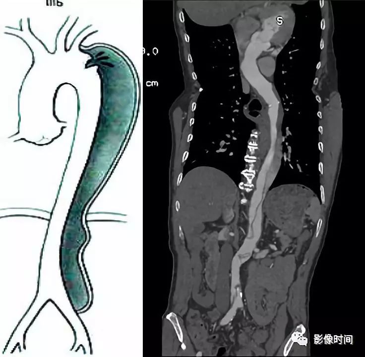 急性主动脉综合征影像 急性主动脉综合征影像