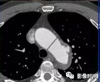 急性主动脉综合征影像 急性主动脉综合征影像
