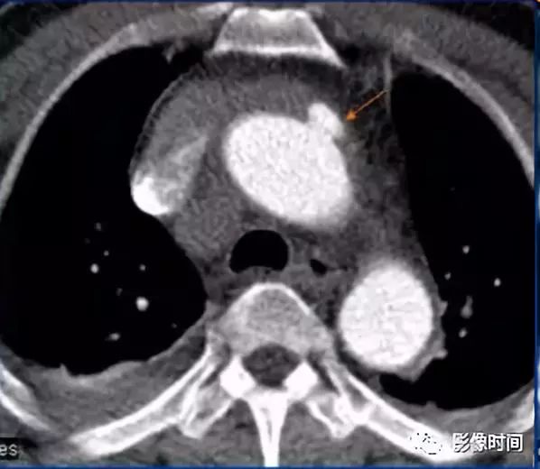 急性主动脉综合征影像 急性主动脉综合征影像
