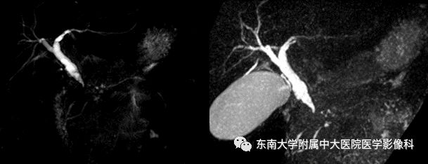 【PPT】常见恶性胆道梗阻疾病影像学表现