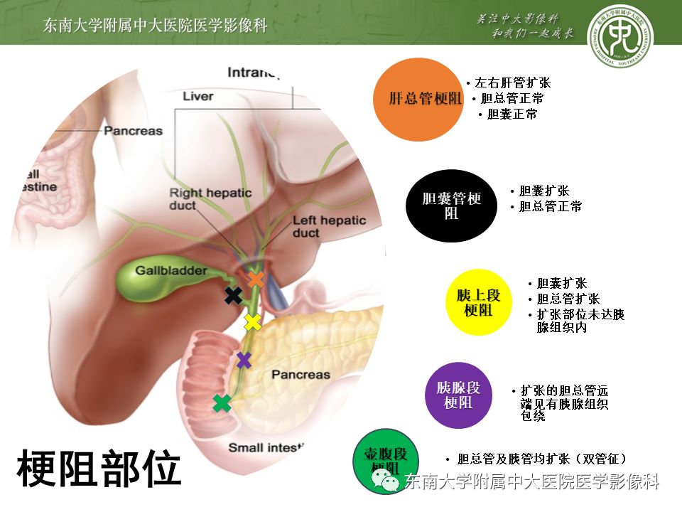 【PPT】常见恶性胆道梗阻疾病影像学表现