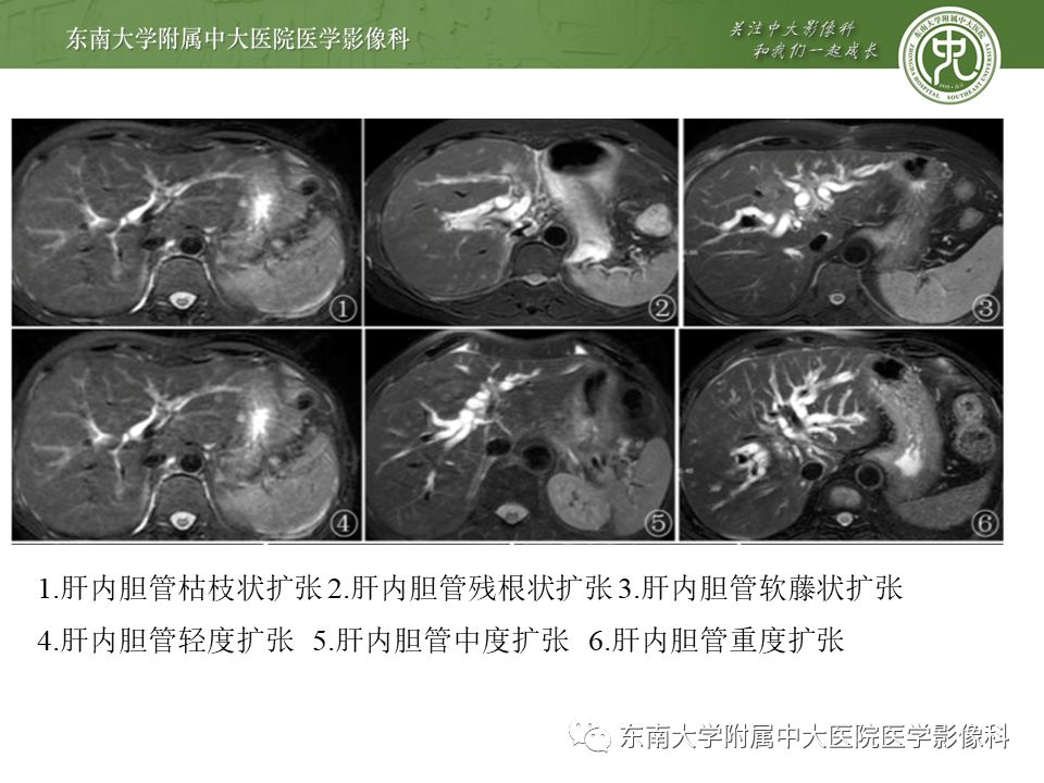 【PPT】常见恶性胆道梗阻疾病影像学表现