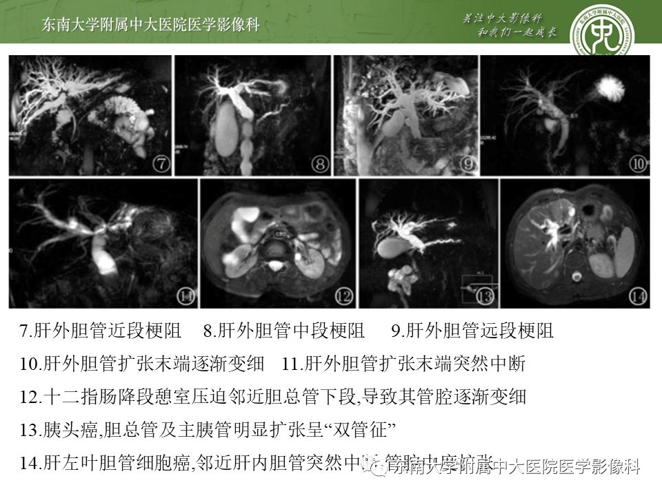 【PPT】常见恶性胆道梗阻疾病影像学表现