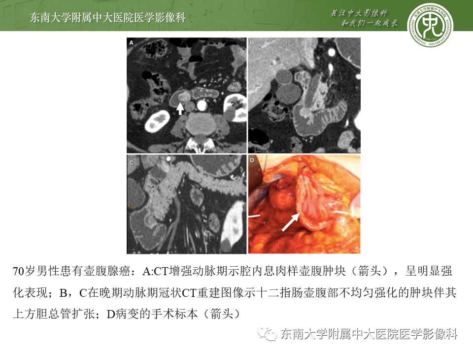 【PPT】常见恶性胆道梗阻疾病影像学表现