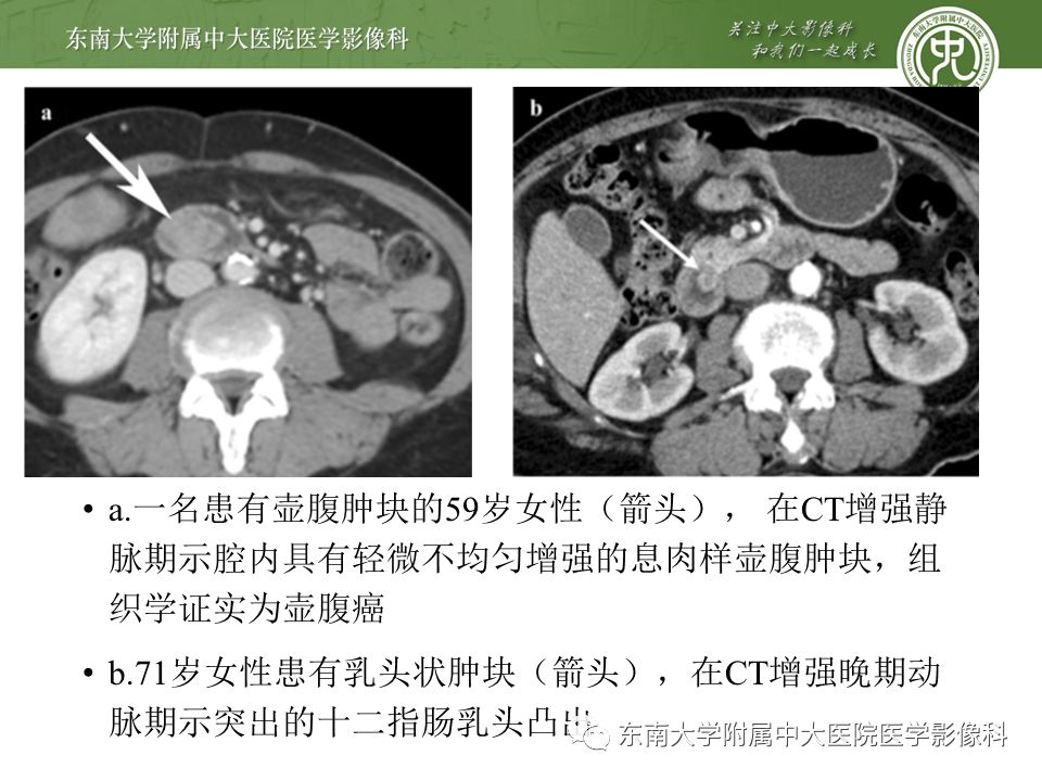 【PPT】常见恶性胆道梗阻疾病影像学表现