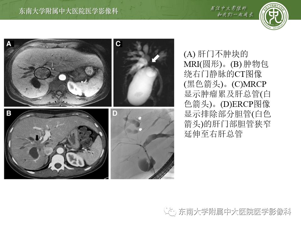 【PPT】常见恶性胆道梗阻疾病影像学表现