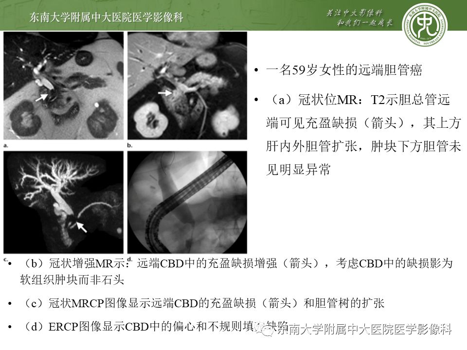 【PPT】常见恶性胆道梗阻疾病影像学表现