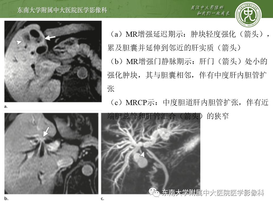 【PPT】常见恶性胆道梗阻疾病影像学表现