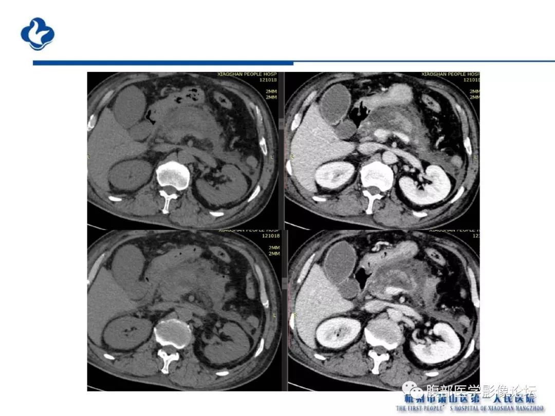【PPT】胰腺炎病例复习—胰腺炎影像表现及并发症影像评估
