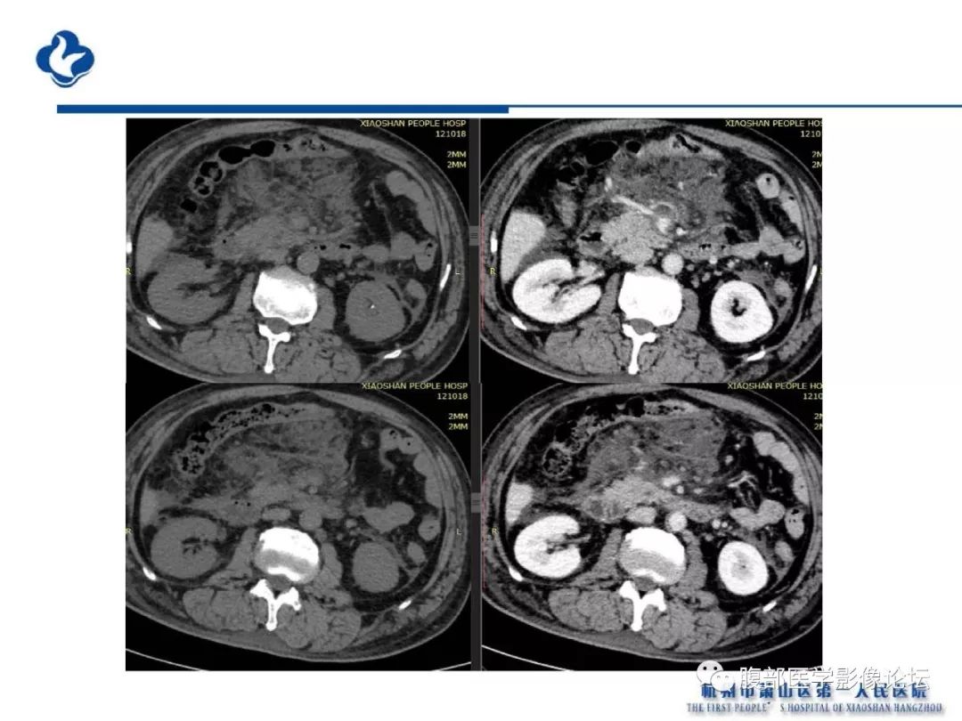 【PPT】胰腺炎病例复习—胰腺炎影像表现及并发症影像评估