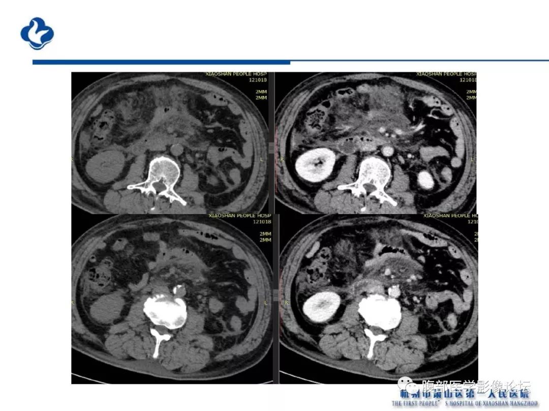 【PPT】胰腺炎病例复习—胰腺炎影像表现及并发症影像评估