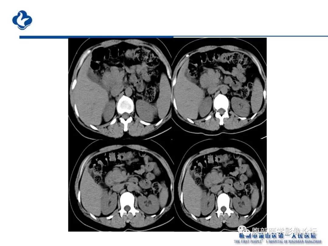 【PPT】胰腺炎病例复习—胰腺炎影像表现及并发症影像评估
