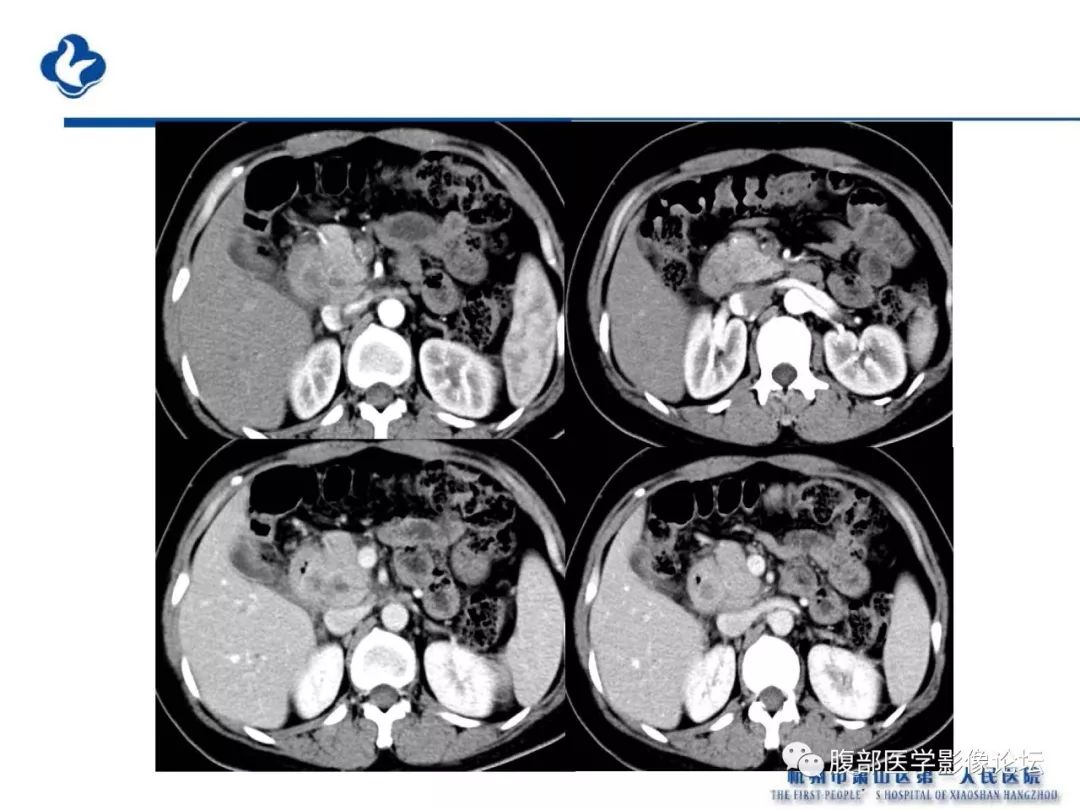 【PPT】胰腺炎病例复习—胰腺炎影像表现及并发症影像评估