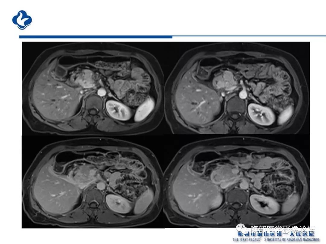 【PPT】胰腺炎病例复习—胰腺炎影像表现及并发症影像评估