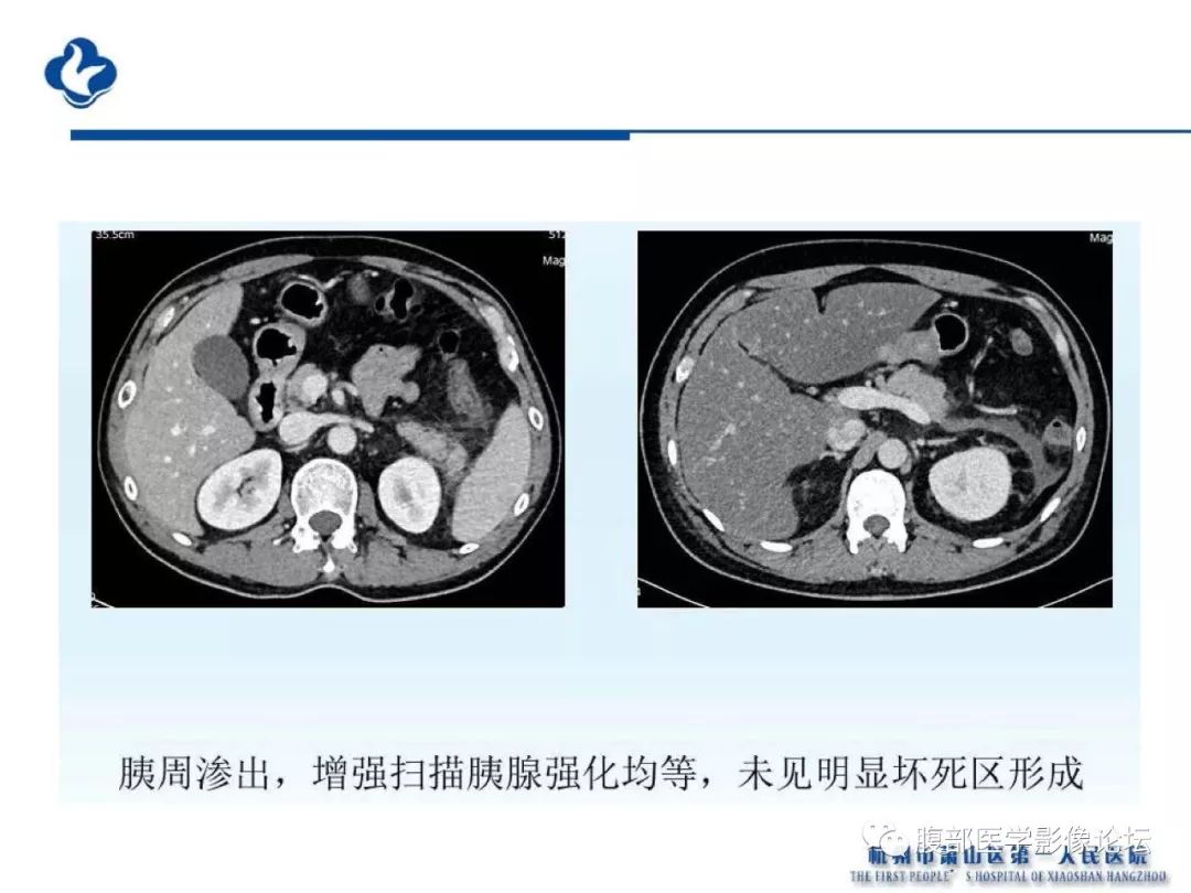【PPT】胰腺炎病例复习—胰腺炎影像表现及并发症影像评估