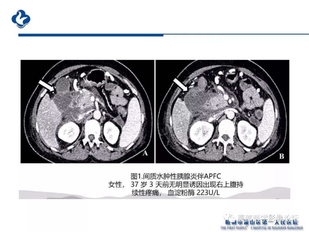 【PPT】胰腺炎病例复习—胰腺炎影像表现及并发症影像评估