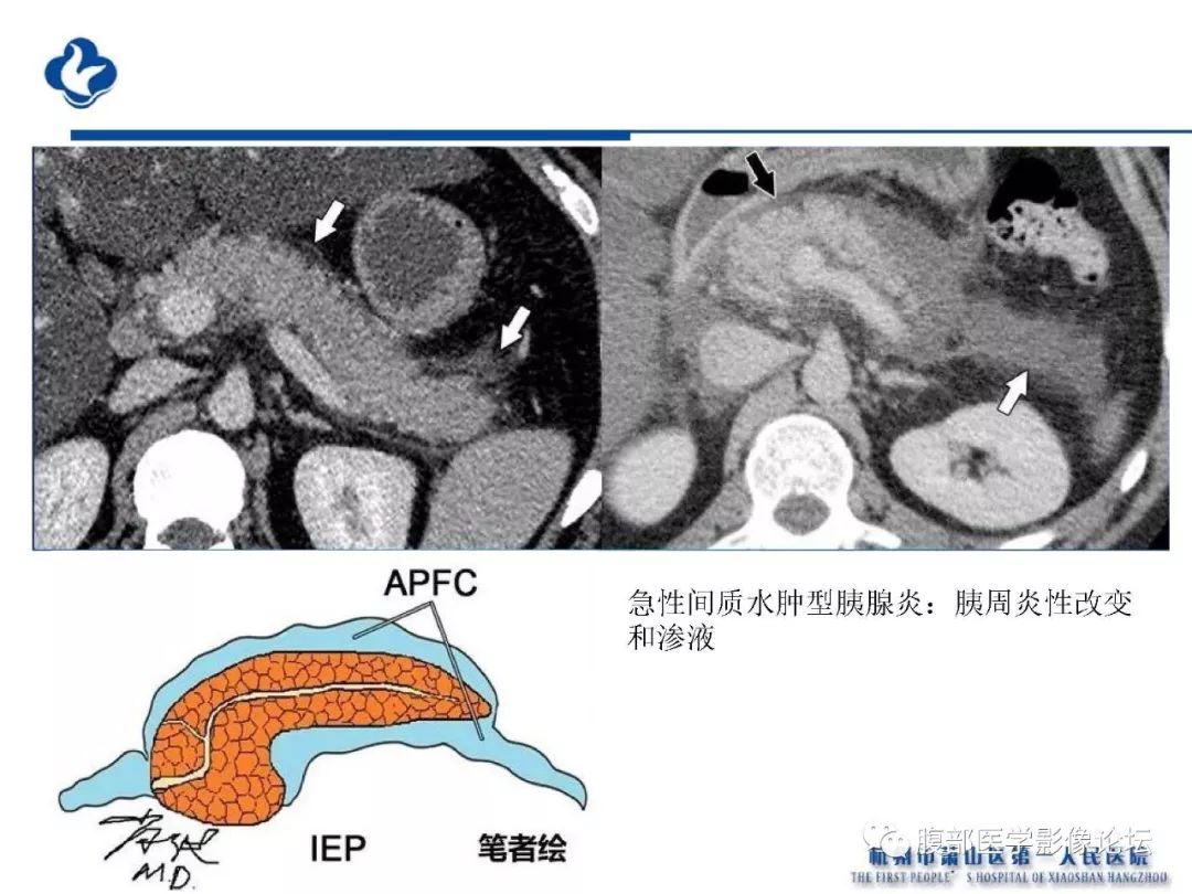 【PPT】胰腺炎病例复习—胰腺炎影像表现及并发症影像评估
