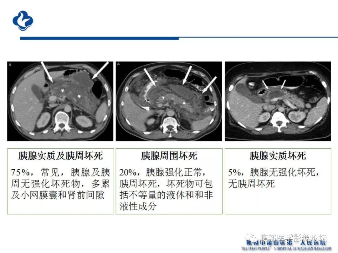 【PPT】胰腺炎病例复习—胰腺炎影像表现及并发症影像评估