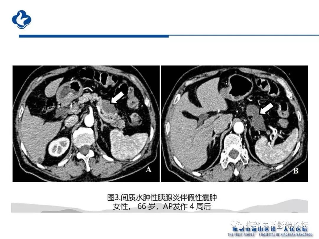 【PPT】胰腺炎病例复习—胰腺炎影像表现及并发症影像评估