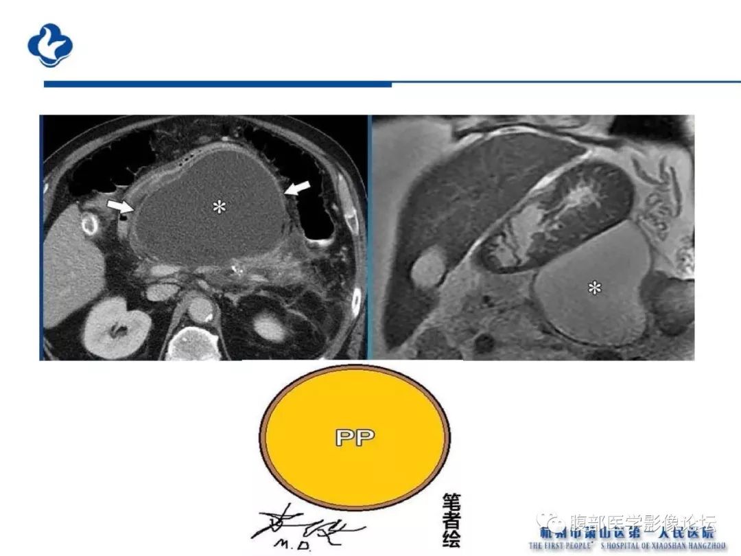 【PPT】胰腺炎病例复习—胰腺炎影像表现及并发症影像评估
