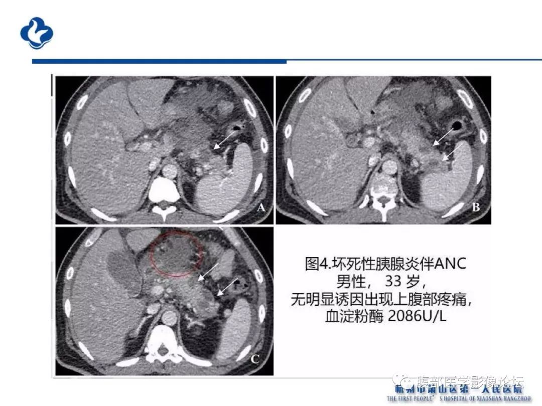 【PPT】胰腺炎病例复习—胰腺炎影像表现及并发症影像评估