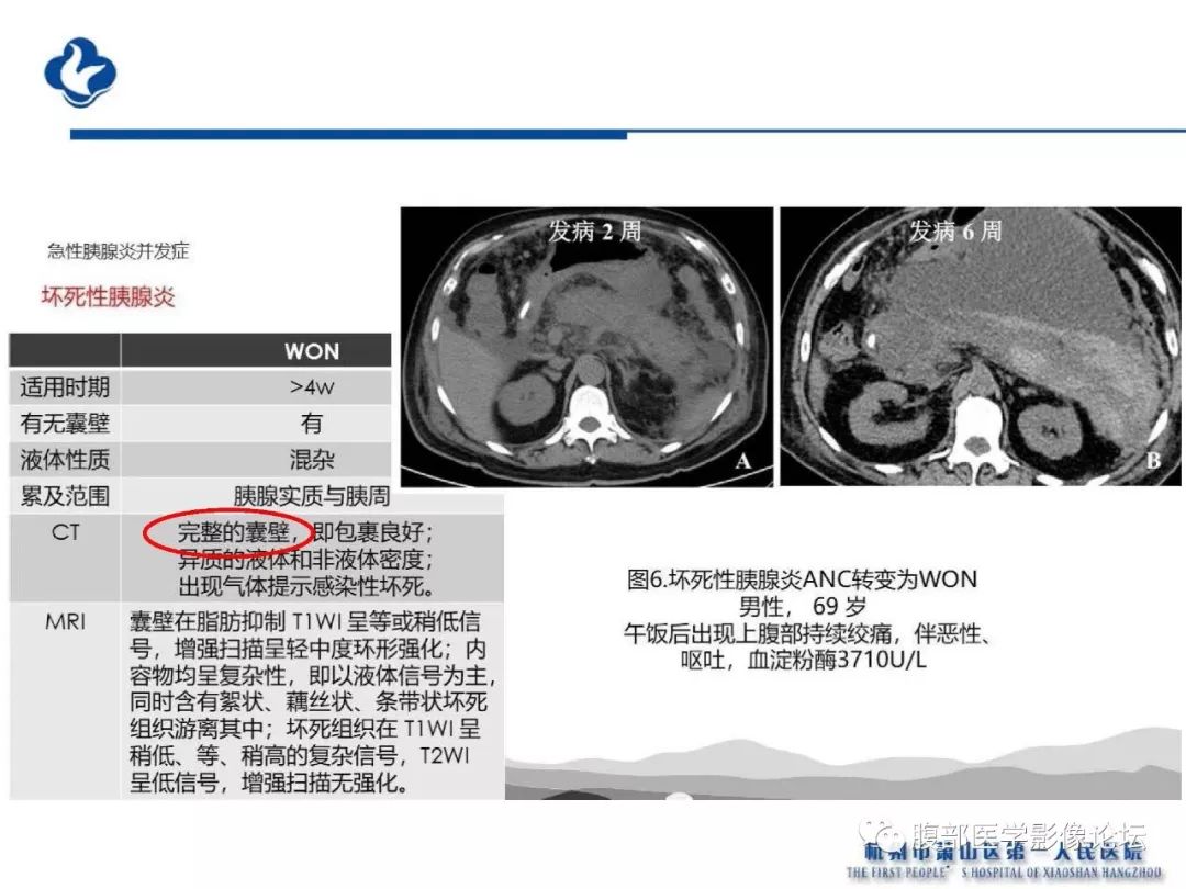 【PPT】胰腺炎病例复习—胰腺炎影像表现及并发症影像评估