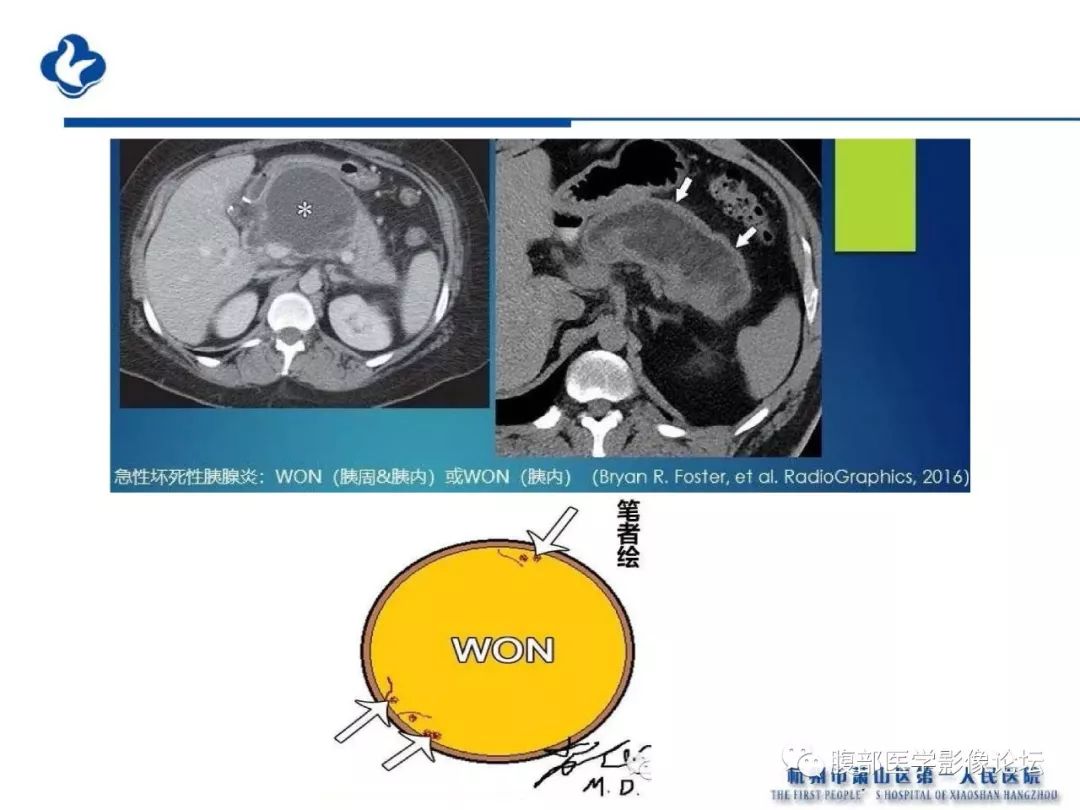 【PPT】胰腺炎病例复习—胰腺炎影像表现及并发症影像评估