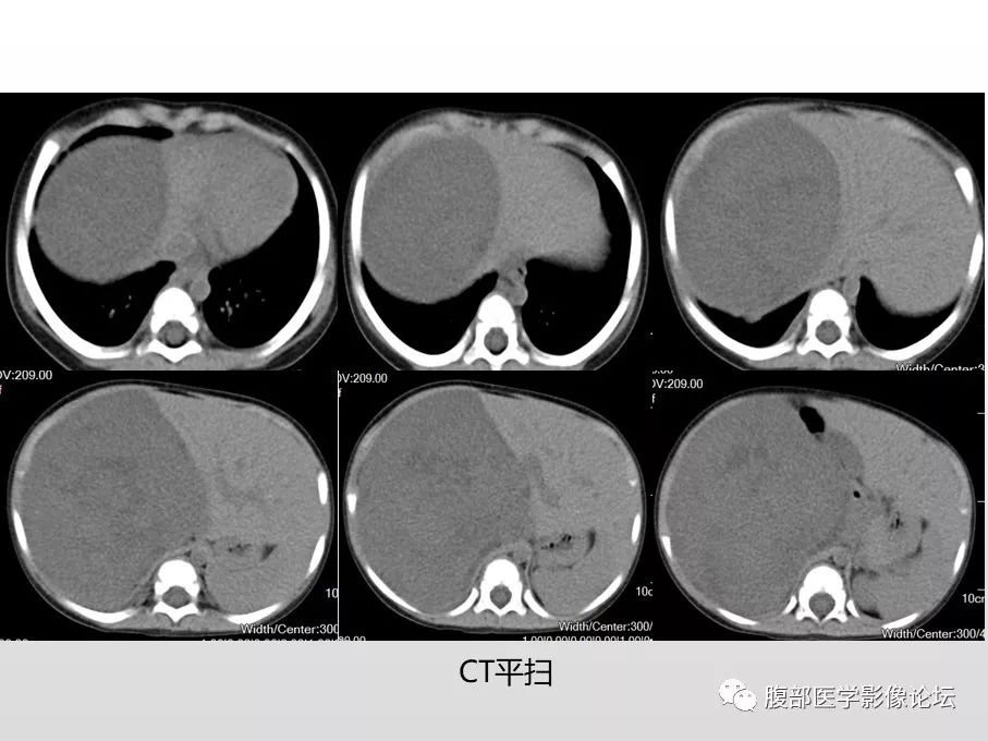 【病例】肾透明细胞肉瘤1例影像表现