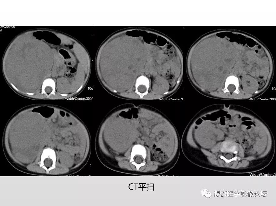 【病例】肾透明细胞肉瘤1例影像表现