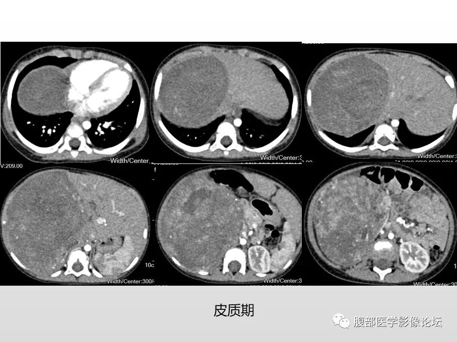 【病例】肾透明细胞肉瘤1例影像表现