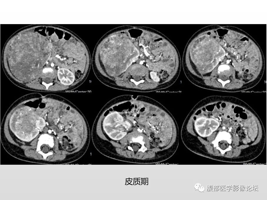 【病例】肾透明细胞肉瘤1例影像表现