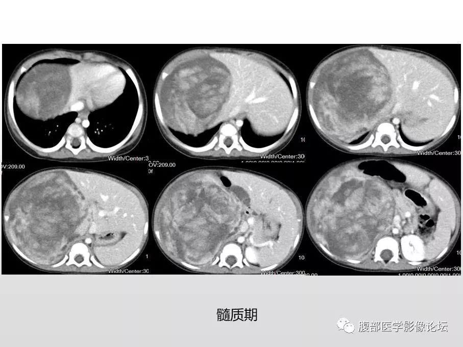 【病例】肾透明细胞肉瘤1例影像表现