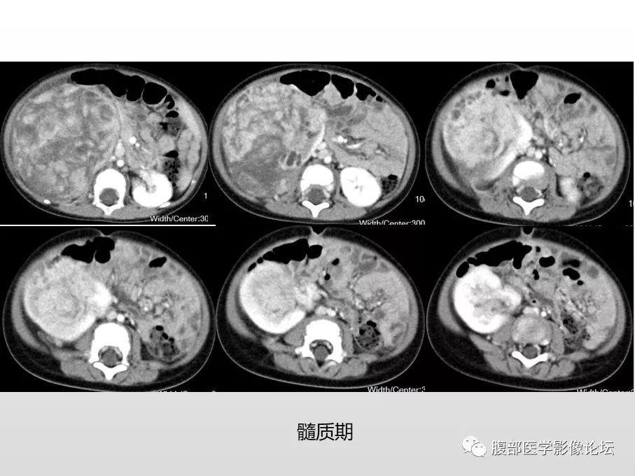 【病例】肾透明细胞肉瘤1例影像表现